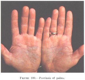 Psoriasis_of_the_palms