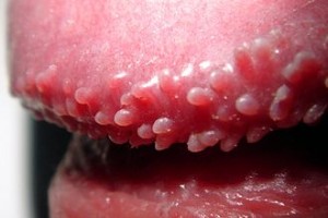 330px-Hirsuties_papillaris_coronae_glandis_enlarged