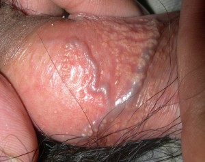 Fordyce_spots_1