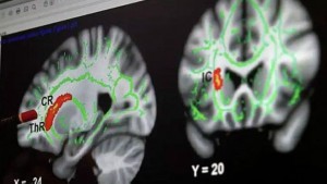 Alteraciones en el cerebro de pedófilos