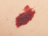 manchas-en-la-piel-melanoma