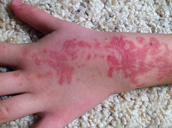 Así quedó la mano de un menor de cinco años luego de tener una reacción con 'henna negra'.