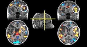 fda-aprueba-nuevo-dispositivo-para-prevenir-derrame-cerebral