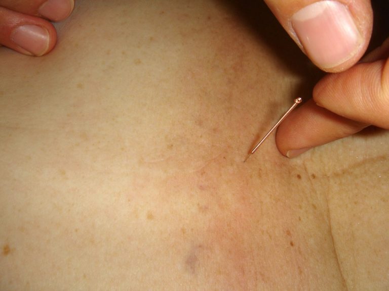 acupuntura-1