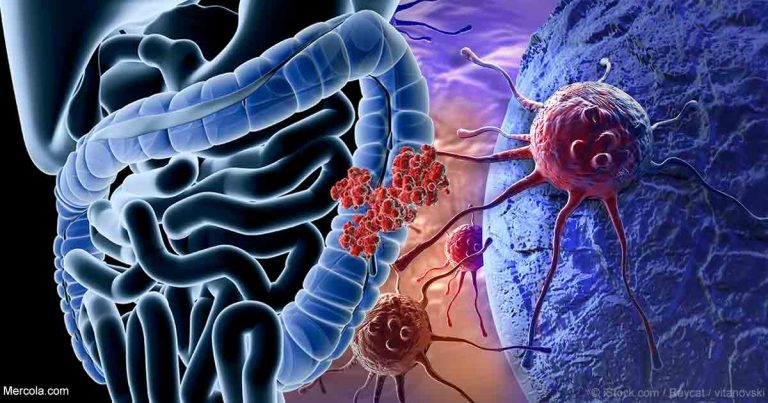 colon-cancer-fb