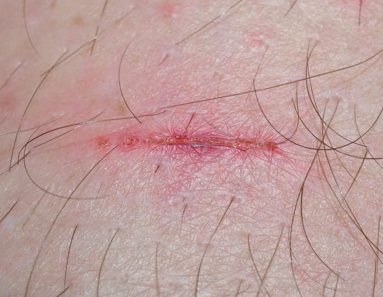 wound-321361_1920