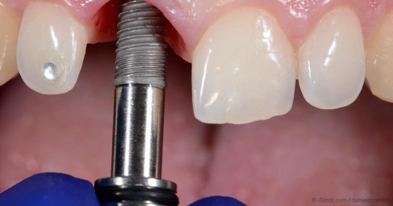 dental-implant-fb