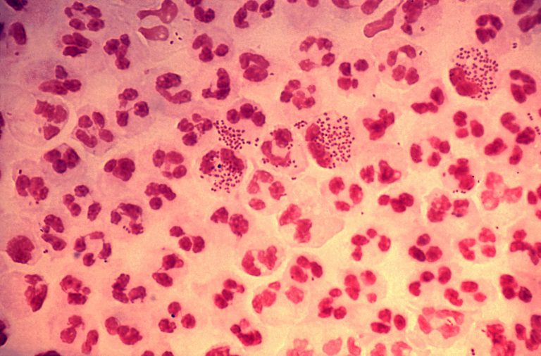 Histopathology in an acute case of gonococcal urethritis using g