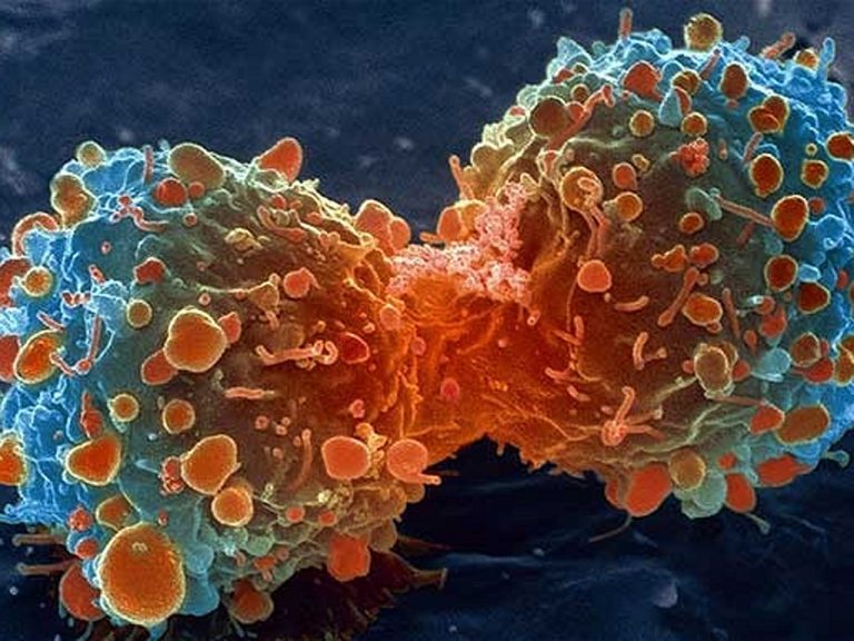 cáncer