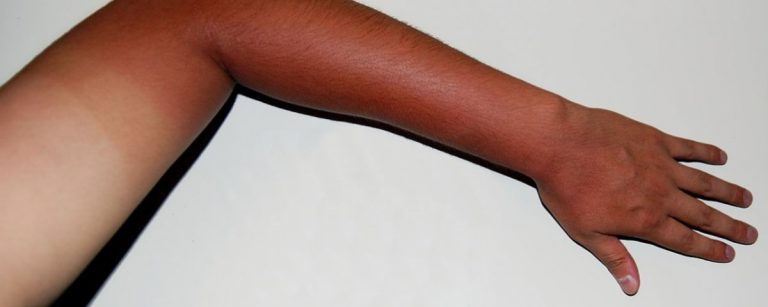 1280px-skin_tanning