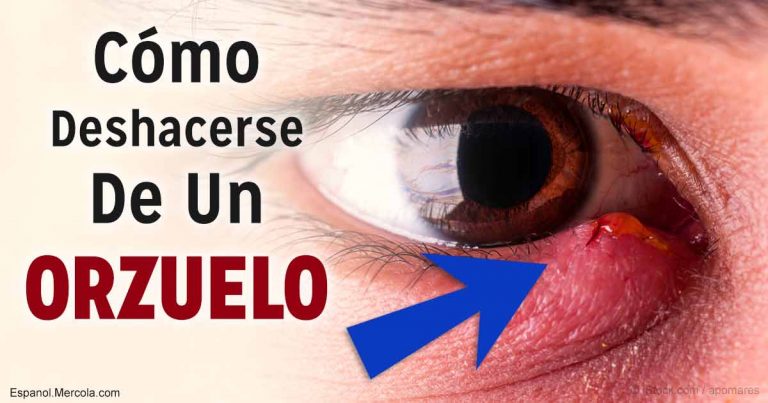 como-deshacerse-orzuelo-fb