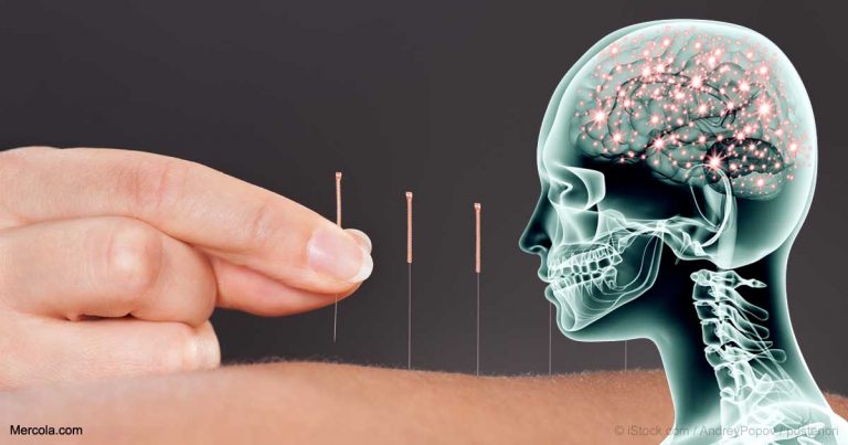 accupunctures-ability-reduce-pain-fb-1