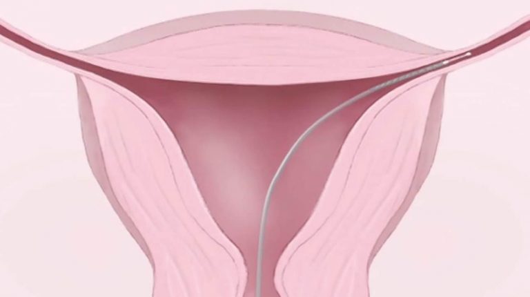 essure567