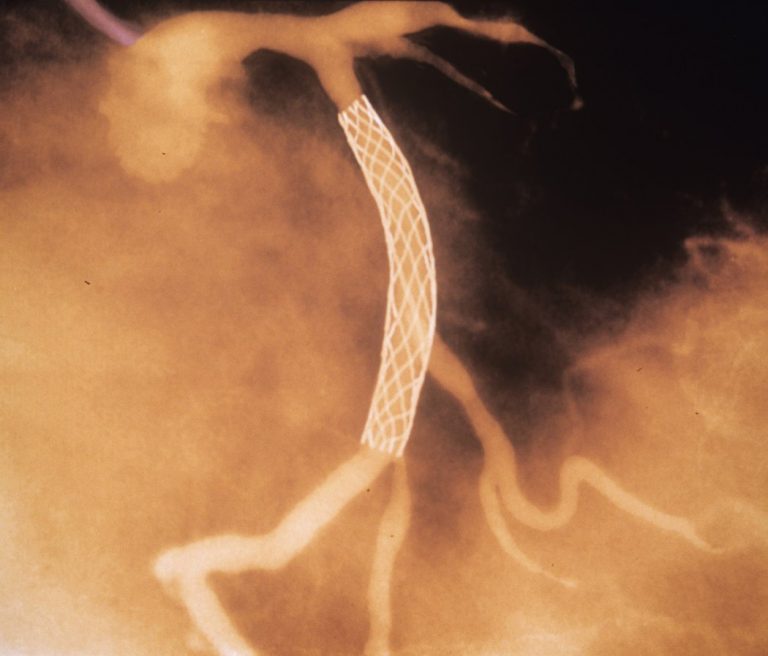 03STENT1-master1050