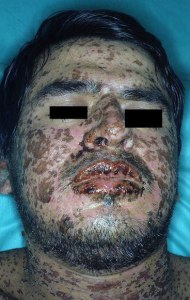 Persona afectada por el Síndrome de Stevens Johnson.