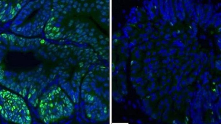 prostatecancercells-k7CG-1240x698@abc-kIFF-1240x698@abc