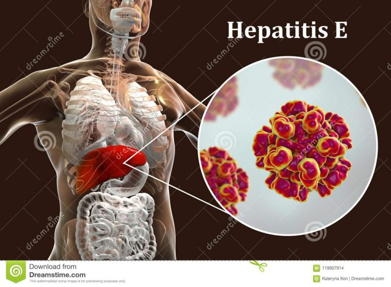 infección-viral-de-la-hepatitis-e-119907914
