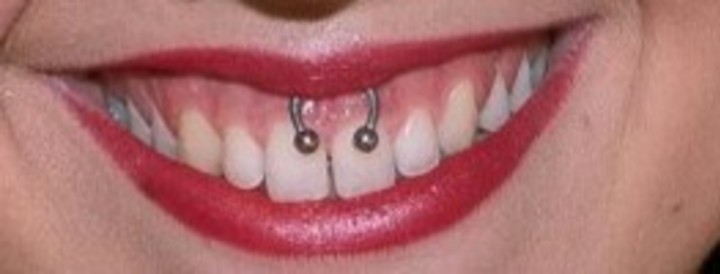 Smile. Este piercing se coloca en el frenillo superior.