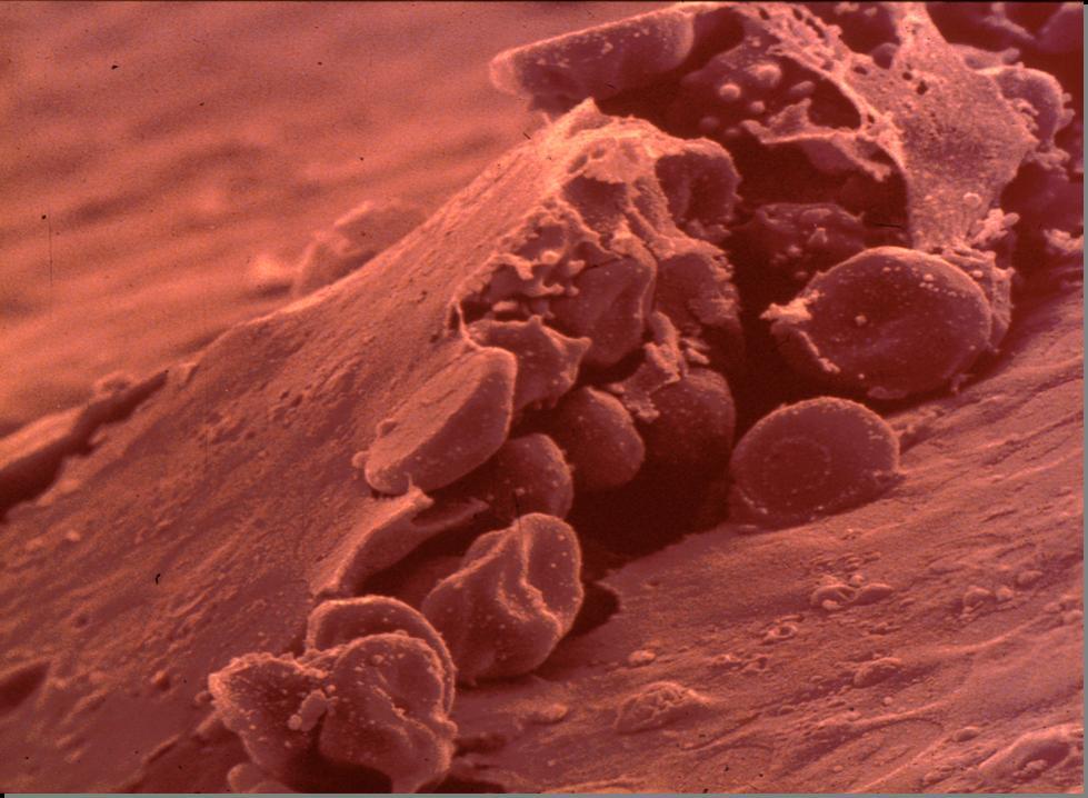 Placa de ateroma levantada peligrosamente en una arteria coronaria, donde se observa un importante conglomerado de células sanguíneas tratando de reparar el defecto.