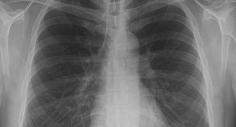 pulmones