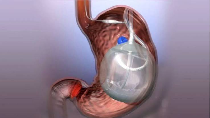 balon gastrico