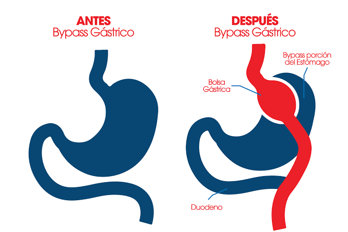 cinturon gastrico
